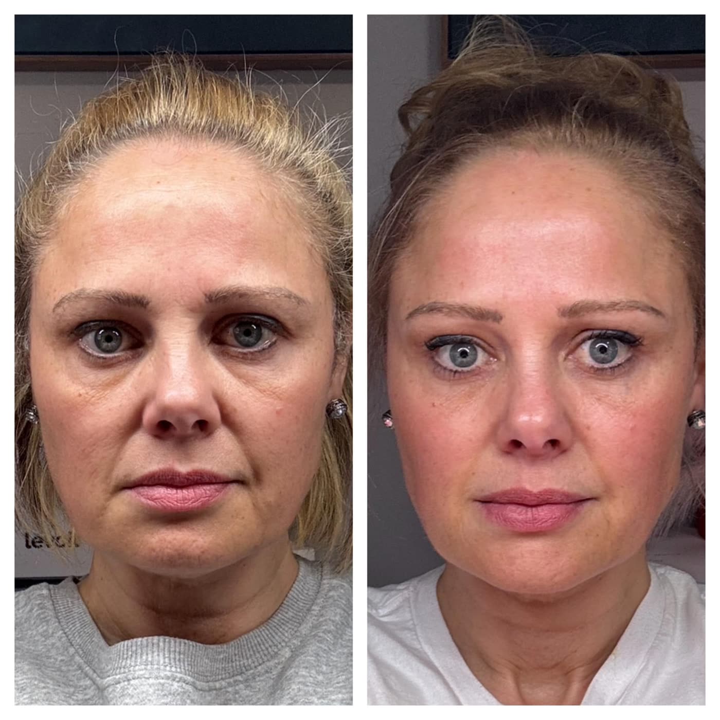 Before and after PlasmaChanneling: full face, lifted cheeks and brighter, more even tone
