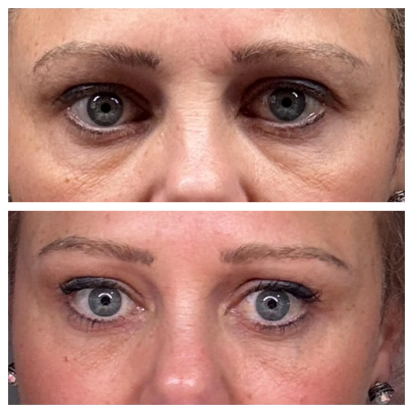 Before and after PlasmaChanneling: under-eye area, softer lines and reduced puffiness