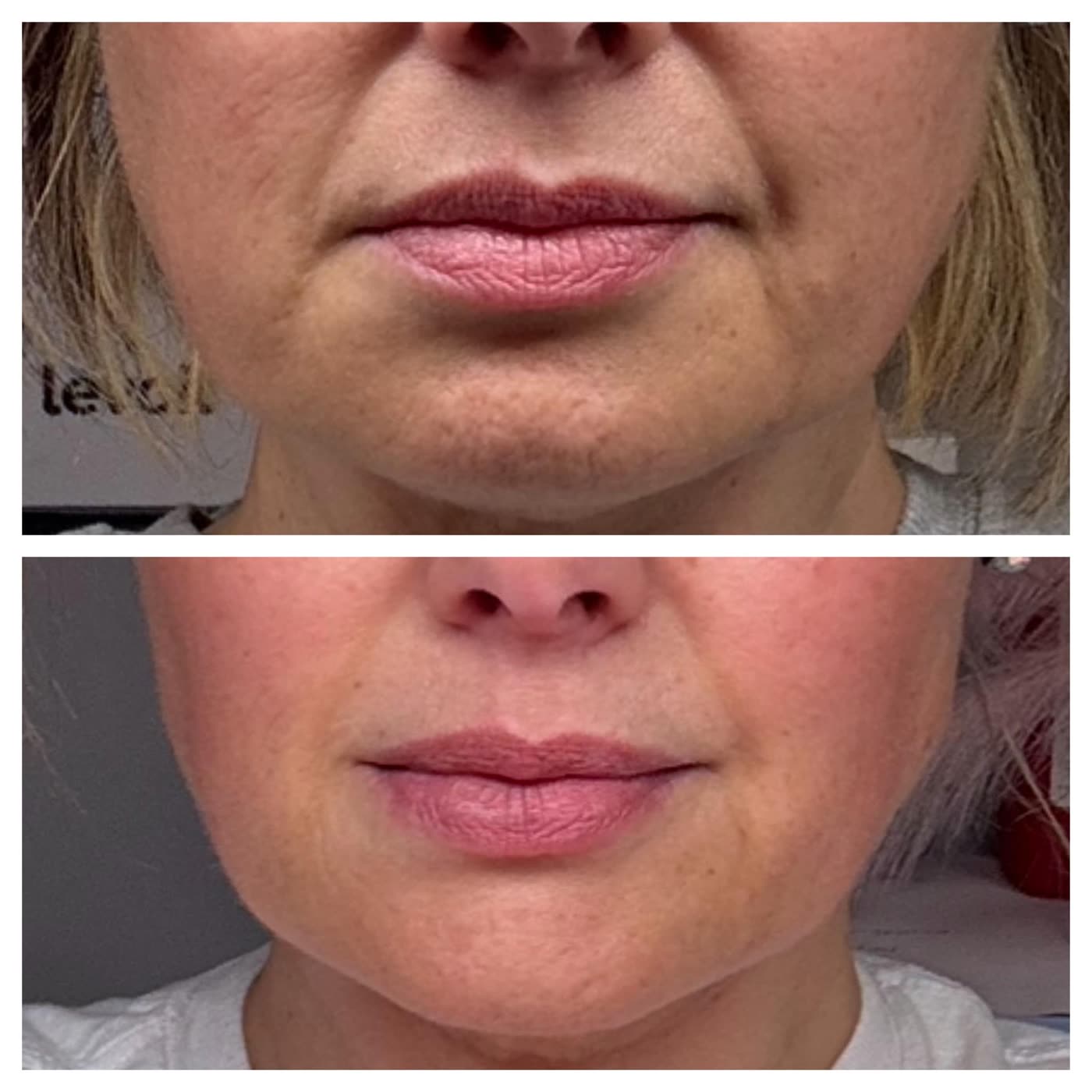 Before and after PlasmaChanneling: mouth and chin, softened lip lines and smoother texture