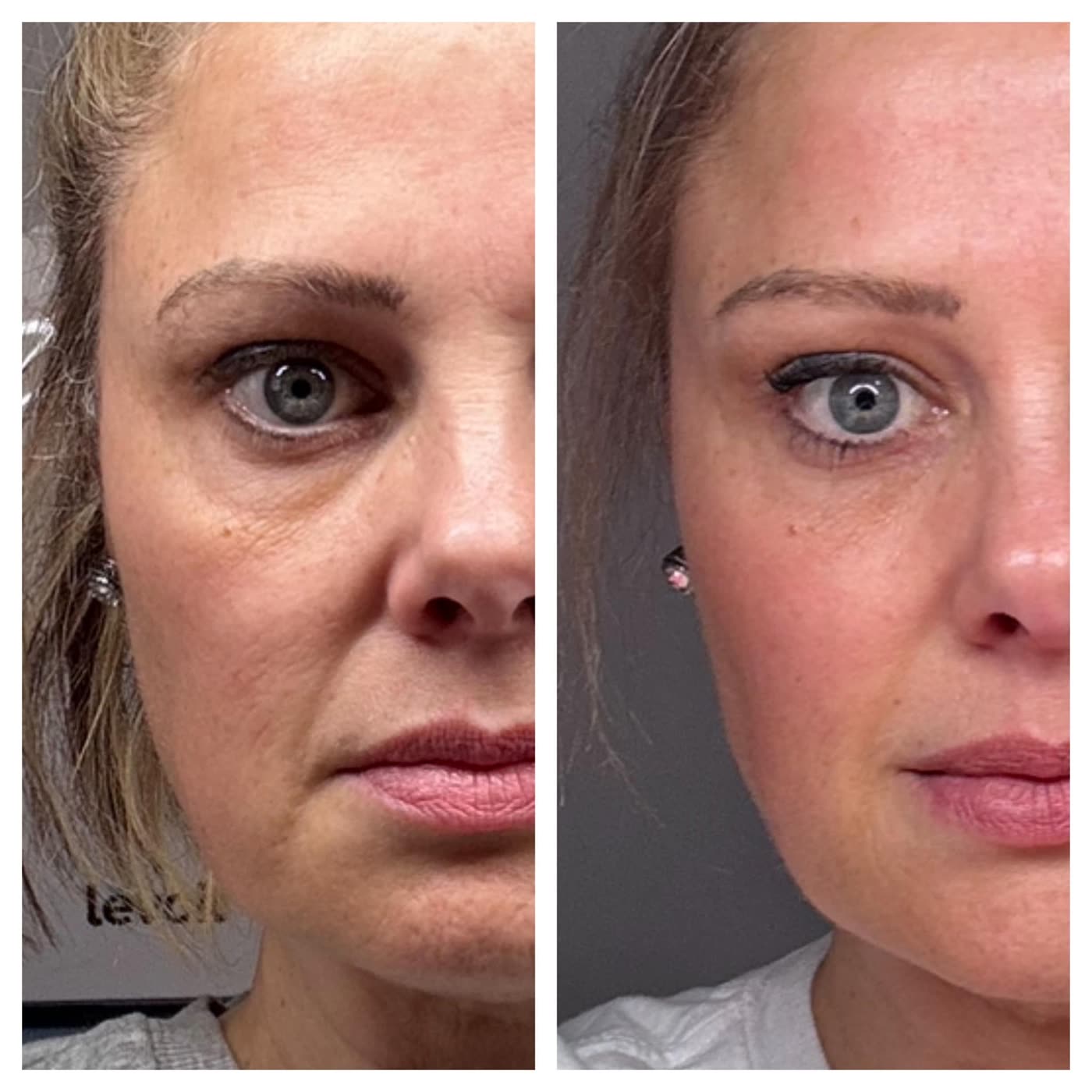 Before and after PlasmaChanneling: side view, tighter cheek and jaw and brighter tone