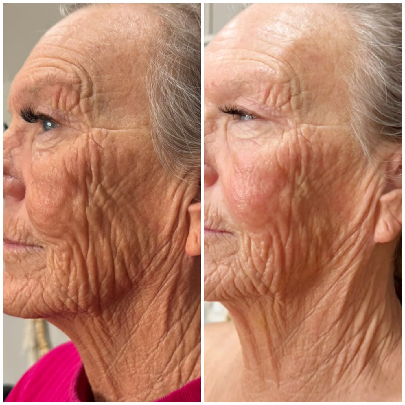 Before and after PlasmaChanneling: neck and jawline, smoother texture and tighter skin