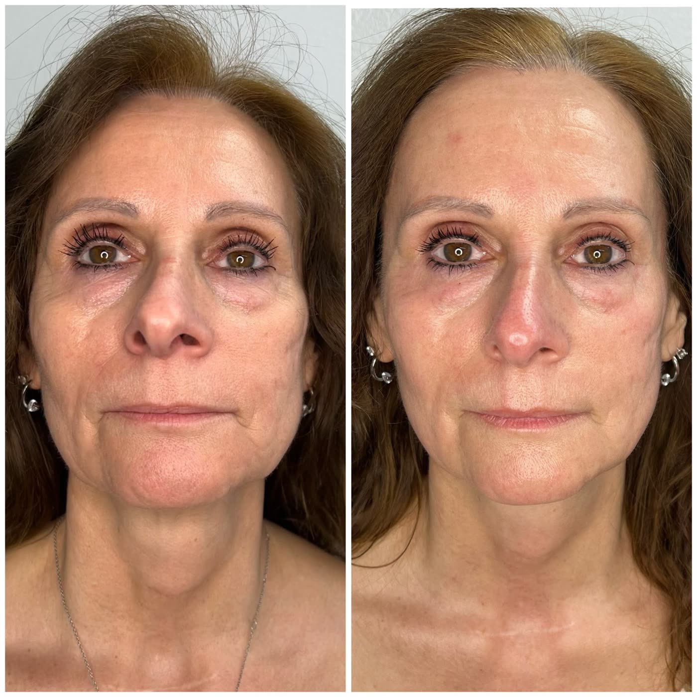 Before and after PlasmaChanneling: full face, firmer contours and more even skin tone