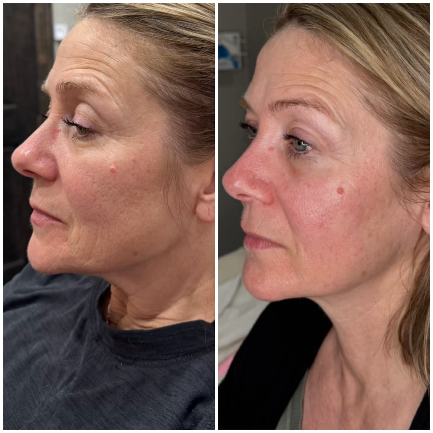 Before and after PlasmaChanneling: side profile, lifted jawline and smoother cheek