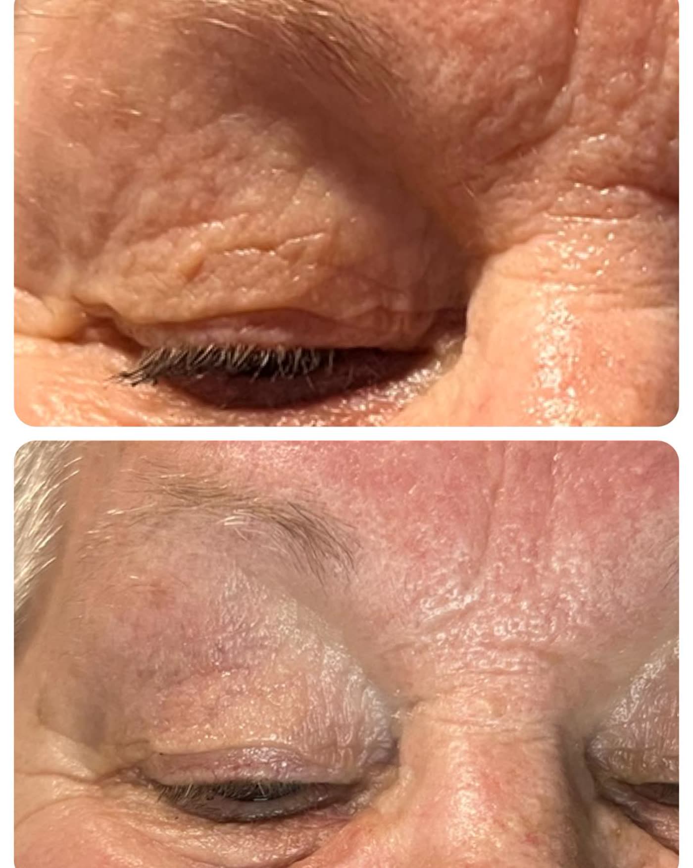 Before and after PlasmaChanneling: eye area, smoother crepey skin and softened crow's feet